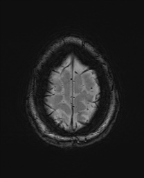 File:Cerebral cavernous venous malformation (Radiopaedia 70008-80021 I 68).jpg