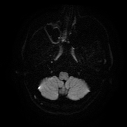 Cerebral cavernous venous malformation (Zabramski type II) (Radiopaedia 85511-101198 Axial DWI 39).jpg