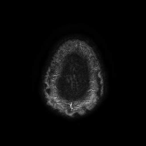 File:Cerebral cavernous venous malformation (Zabramski type II) (Radiopaedia 85511-101198 Axial SWI 114).jpg