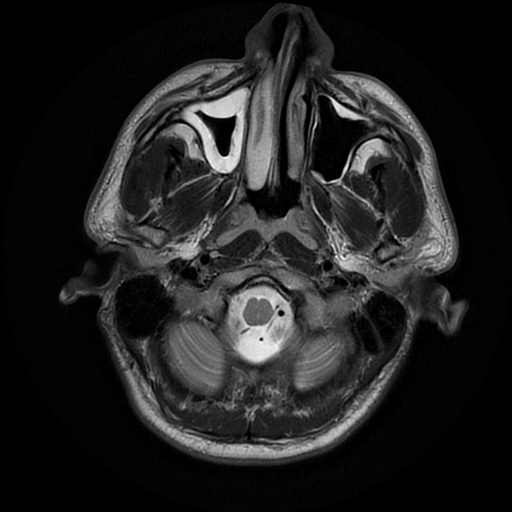 File:Cerebral cavernous venous malformation (Zabramski type II) (Radiopaedia 85511-101198 Axial T2 4).jpg