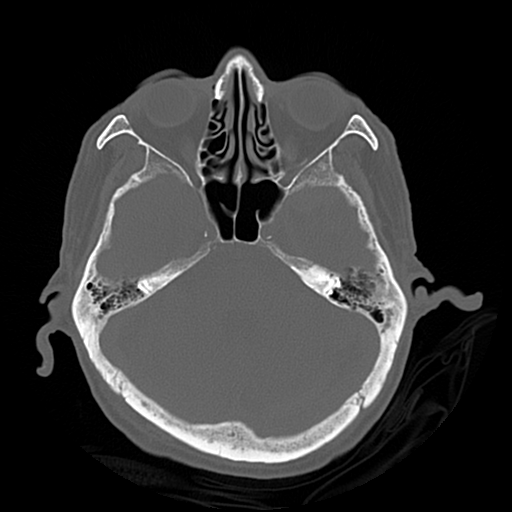 Cerebral contusions, subarachnoid hemorrhage and subdural hygromas (Radiopaedia 55399-61827 Axial bone window 16).png