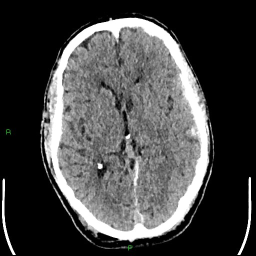 Cerebral contusions (Radiopaedia 33868-35039 Axial non-contrast 103).jpg