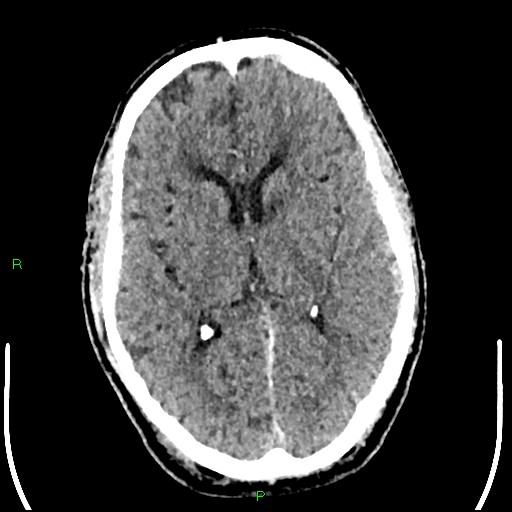 Cerebral contusions (Radiopaedia 33868-35039 Axial non-contrast 109).jpg