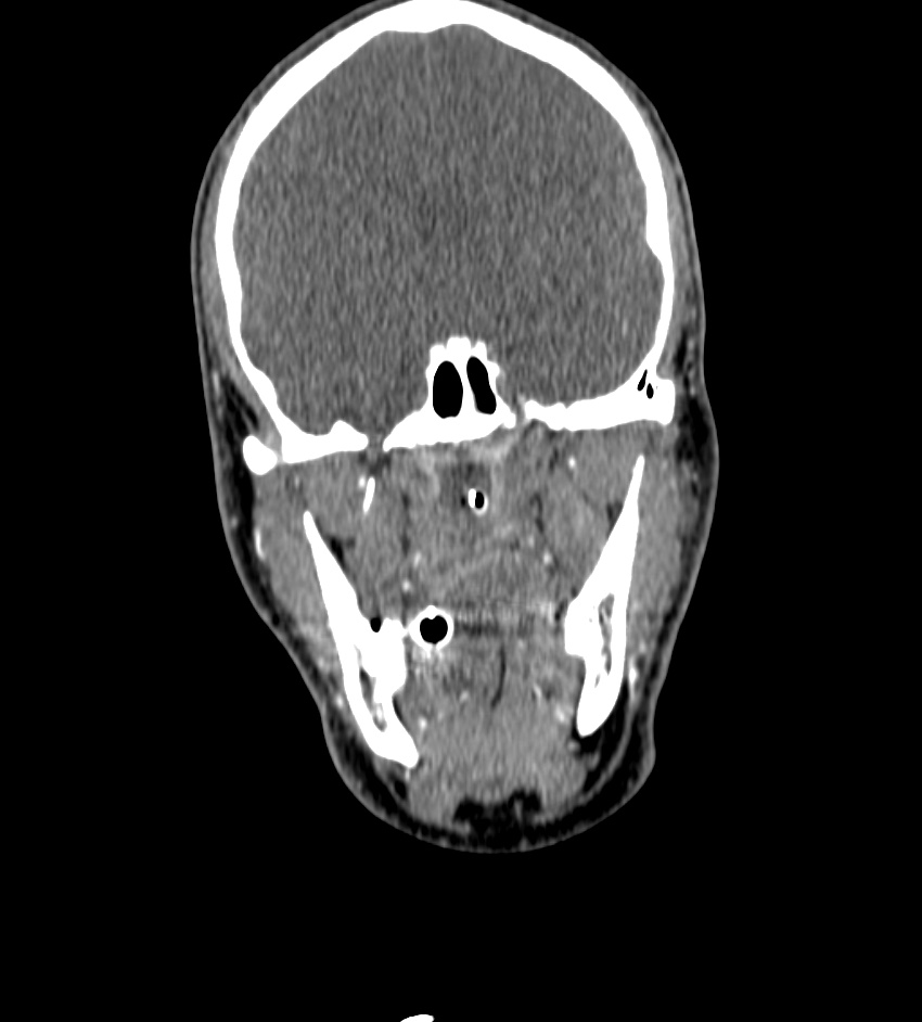 Cerebral edema in an overdose patient (Radiopaedia 72005-82539 B 22).jpg