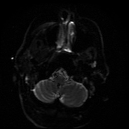 Cerebral embolic infarcts (embolic shower) (Radiopaedia 49837-55108 Axial DWI 42).jpg