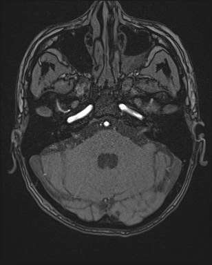 Cerebral embolic infarcts (embolic shower) (Radiopaedia 72391-82921 Axial MRA 24).jpg