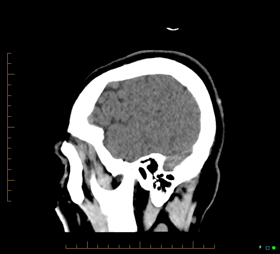 Cerebral fat embolism (Radiopaedia 85521-101220 B 45).jpg