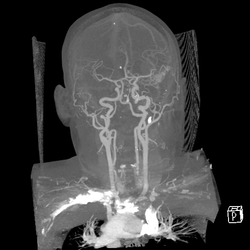 File:Cerebral hemorrhage secondary to arteriovenous malformation (Radiopaedia 33497-34571 A 37).png