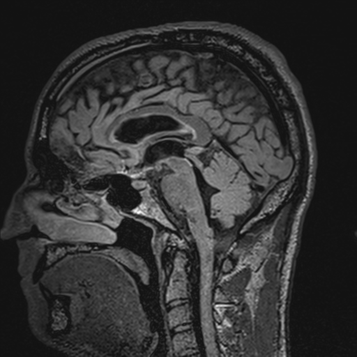 File:Cerebral hemorrhagic contusions- temporal evolution (Radiopaedia 40224-42757 Sagittal T1 40).png