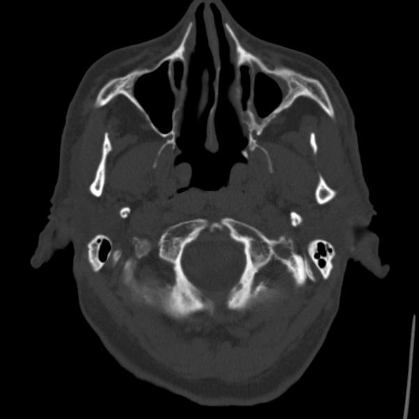 Cerebral hemorrhagic contusions (Radiopaedia 23145-23188 Axial bone window 4).jpg
