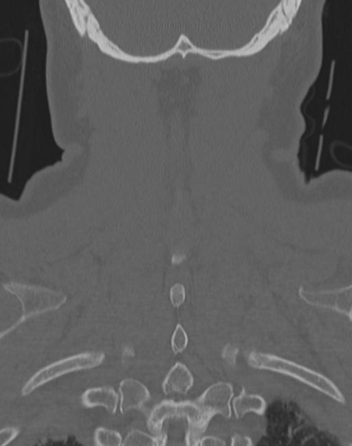 Cerebral hemorrhagic contusions and cervical spine fractures (Radiopaedia 32865-33841 Coronal bone window 66).jpg