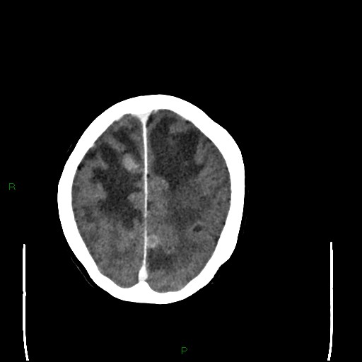 Cerebral metastases - breast primary (Radiopaedia 77653-89857 Axial C+ delayed 91).jpg