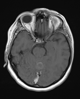 File:Cerebral metastases mimicking abscesses (Radiopaedia 45841-50131 Axial T1 C+ fat sat 11).png