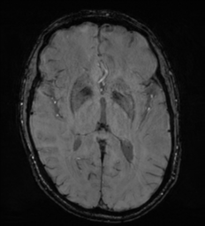 Cerebral metastasis - melanoma (Radiopaedia 54718-60954 Axial SWI 28).png