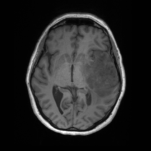 Cerebral metastasis mimicking glioblastoma (Radiopaedia 69155-78937 Axial T1 29).png