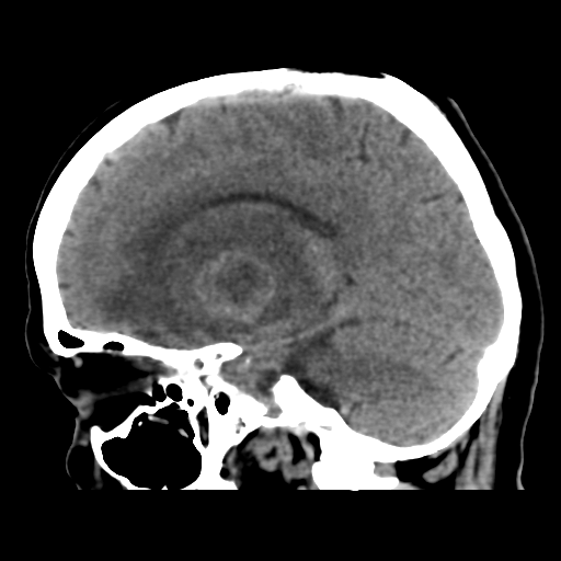 Cerebral metastasis to basal ganglia (Radiopaedia 81568-95412 E 27).png