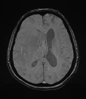Cerebral metastasis to basal ganglia (Radiopaedia 81568-95413 Axial SWI magnitude 51).png