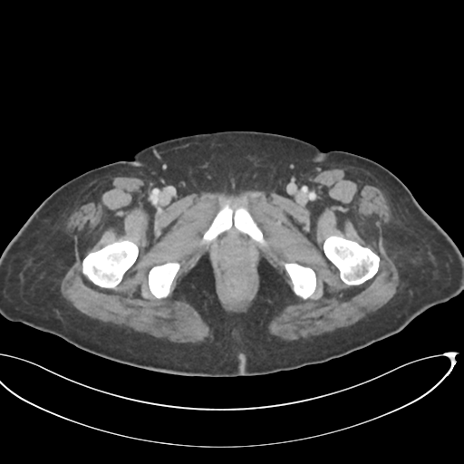 File:Cerebral metastasis to basal ganglia (Radiopaedia 81568-95414 E 80).png