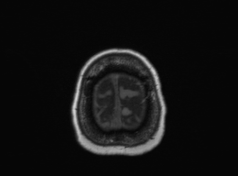 Cerebral ring enhancing lesions - cerebral metastases (Radiopaedia 44922-48817 Axial T1 109).jpg