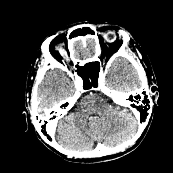 Cerebral ring enhancing lesions - cerebral metastases (Radiopaedia 44922-48818 B 85).jpg