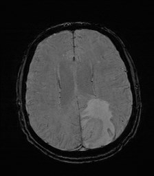 File:Cerebral toxoplasmosis (Radiopaedia 43956-47461 Axial SWI 26).jpg