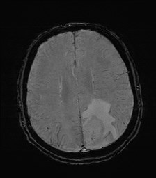 File:Cerebral toxoplasmosis (Radiopaedia 43956-47461 Axial SWI 27).jpg