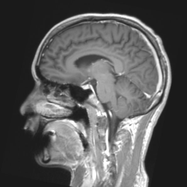 File:Cerebral toxoplasmosis (Radiopaedia 53993-61435 Coronal T1 19).jpg