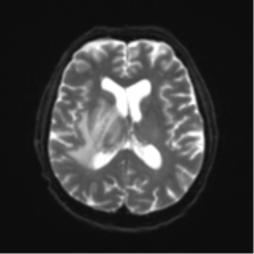 File:Cerebral toxoplasmosis (Radiopaedia 54575-60804 Axial DWI 19).png