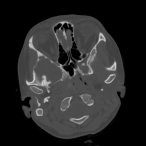 Cerebral tuberculosis with dural sinus invasion (Radiopaedia 60353-68018 Axial bone window 4).jpg
