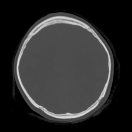 Cerebral tuberculosis with dural sinus invasion (Radiopaedia 60353-68018 Axial bone window 42).jpg