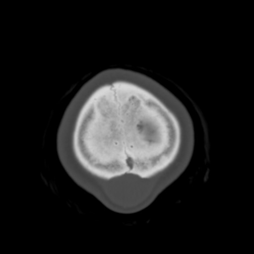 Cerebral tuberculosis with dural sinus invasion (Radiopaedia 60353-68018 Axial bone window 63).jpg