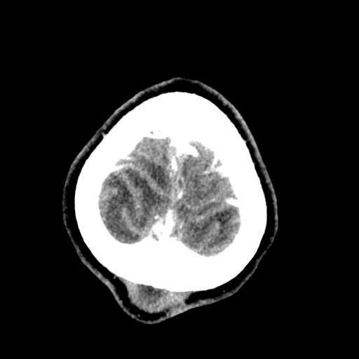 Cerebral tuberculosis with dural sinus invasion (Radiopaedia 60353-68019 Axial C+ delayed 62).jpg