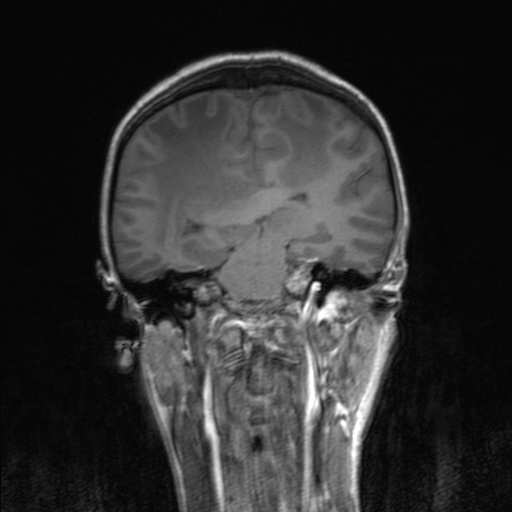 Cerebral tuberculosis with dural sinus invasion (Radiopaedia 60353-68090 Coronal T1 110).jpg