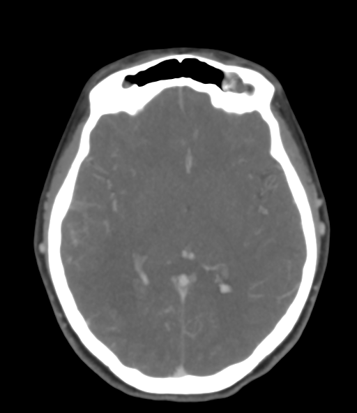 File:Cerebral venous hemorrhagic infarction (Radiopaedia 38461-40550 Axial MIP VENOGRAM 27).png