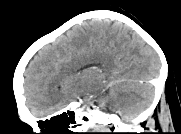 File:Cerebral venous hemorrhagic infarction (Radiopaedia 57576-64538 Sagittal C+ 31).png