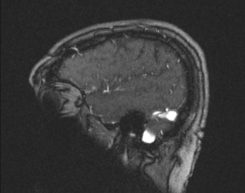 Cerebral venous infarction (Radiopaedia 65166-74176 Sagittal TOF 59).jpg