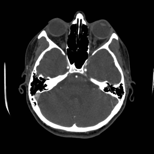 Cerebral venous sinus thrombosis (Radiopaedia 40619-43227 A 64).jpg