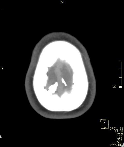 Cerebral venous sinus thrombosis (Radiopaedia 91329-108965 Axial venogram 74).jpg