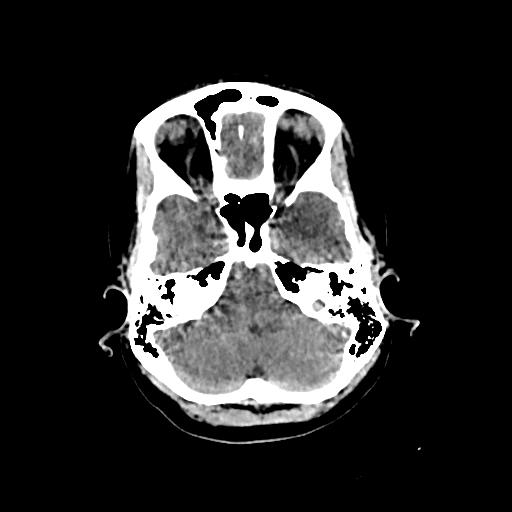 Cerebral venous throbmosis - hemorrhagic venous infarction (Radiopaedia 87318-103613 Axial non-contrast 35).jpg