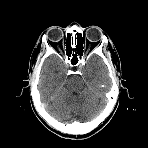 File:Cerebral venous thrombosis (CVT) (Radiopaedia 77524-89685 Axial non-contrast 15).jpg