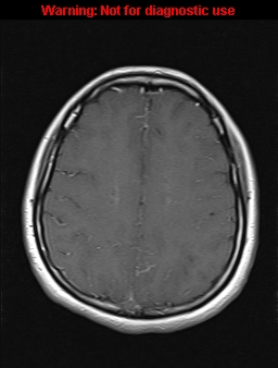 File:Cerebral venous thrombosis (Radiopaedia 37224-39208 Axial T1 C+ 15).jpg