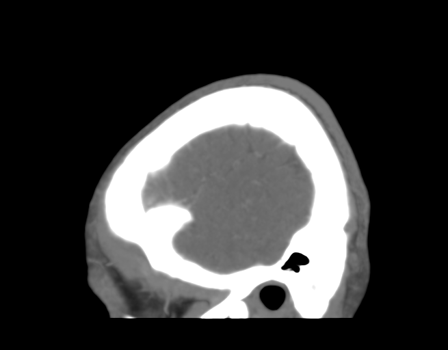 Cerebral venous thrombosis (Radiopaedia 38392-40467 D 6).png