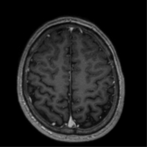 Cerebral venous thrombosis (Radiopaedia 38392-40469 Axial T1 C+ 62).png
