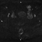 Cervical adenocarcinoma (Radiopaedia 65011-73985 Axial DWI 54).jpg