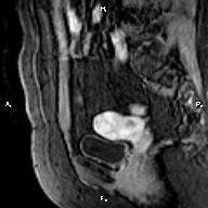 File:Cervical adenocarcinoma (Radiopaedia 65011-73985 E 9).jpg