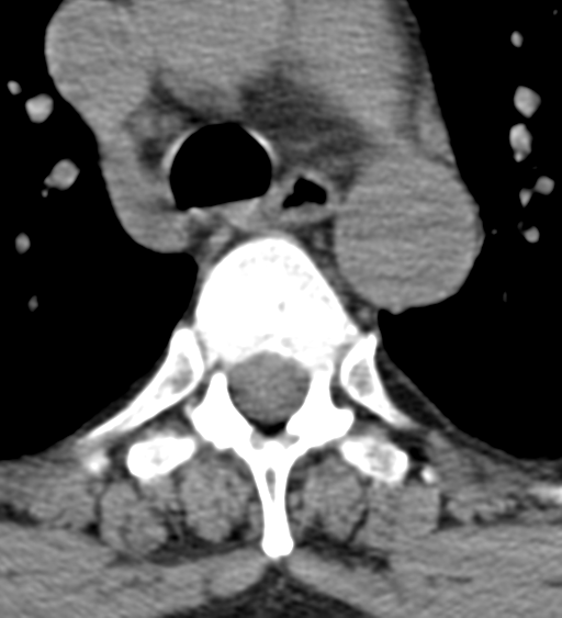 Cervical canal stenosis - OPLL and osteophytes (Radiopaedia 47329-51910 Axial non-contrast 80).png