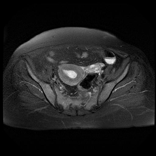 File:Cervical carcinoma (Radiopaedia 88010-104555 Axial T2 fat sat 7).jpg