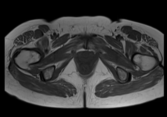 File:Cervical carcinoma (Radiopaedia 88312-104943 Axial T1 19).jpg