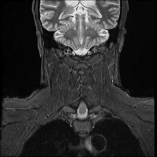 File:Cervical disc extrusion (Radiopaedia 59074-66364 Coronal STIR 9).jpg