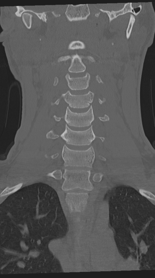 Cervical intercalary bone (Radiopaedia 35211-36748 Coronal bone window 33).png
